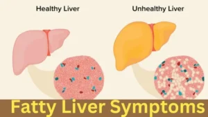 Fatty Liver Symptoms